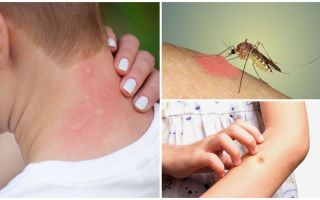 Perché le punture di zanzara prurito